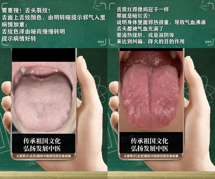 舌诊分析:生气、睡眠紊乱、水湿上泛、忽好忽坏很受影响-生气用中医学怎么说