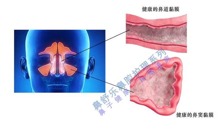 鼻窦炎如何根治?(儿童鼻窦炎的最明显五大症状)