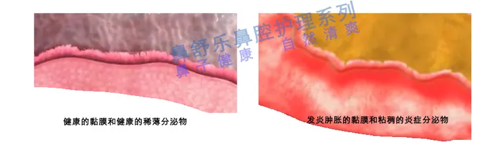 鼻窦炎如何根治?(儿童鼻窦炎的最明显五大症状)