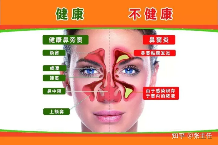 鼻窦炎怎么治疗能够根除?从医50年余年老中医教你这这样做,鼻窦炎远离你!(治疗鼻窦炎的13个偏方)