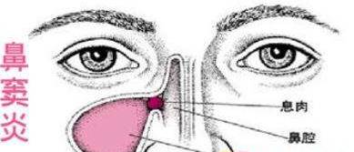 经久不愈的鼻窦炎怎么办?(经久不愈的鼻窦炎怎么办呢)