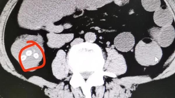 吃完杨梅,肠胃里竟出现密密麻麻小点?医生紧急提醒,千万别这么吃(每吃一颗杨梅就等于吞了六个活蛆)