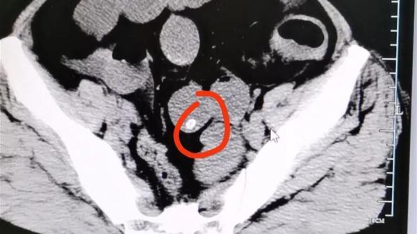 吃完杨梅,肠胃里竟出现密密麻麻小点?医生紧急提醒,千万别这么吃(每吃一颗杨梅就等于吞了六个活蛆)