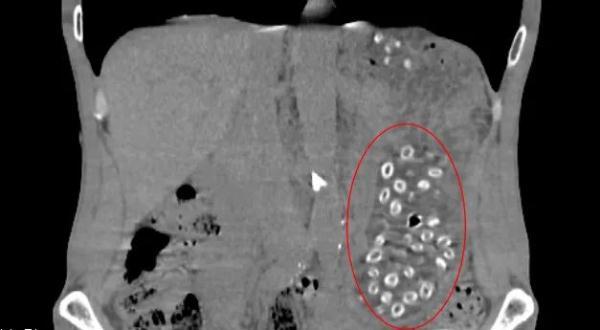 吃完杨梅,肠胃里竟出现密密麻麻小点?医生紧急提醒,千万别这么吃(每吃一颗杨梅就等于吞了六个活蛆)