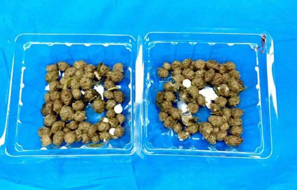 吃完杨梅,肠胃里竟出现密密麻麻小点?医生紧急提醒,千万别这么吃(每吃一颗杨梅就等于吞了六个活蛆)