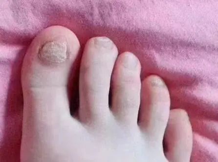 灰指甲最有效的药治疗费用!在家就能清除灰指甲!你一定要试试看!-治灰指甲最好的药是什么药?