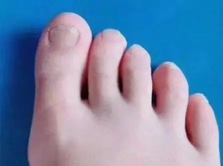 灰指甲最有效的药治疗费用!在家就能清除灰指甲!你一定要试试看!-治灰指甲最好的药是什么药?