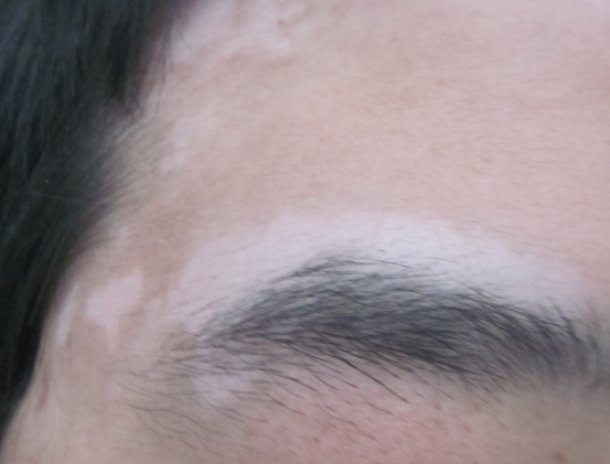 该如何治疗男性的白癜风(男性怎么治)