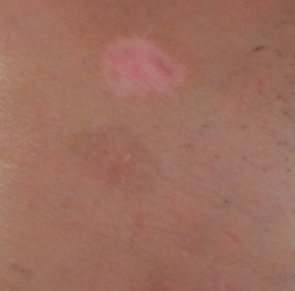 该如何治疗男性患的白癜风(男性怎样治)