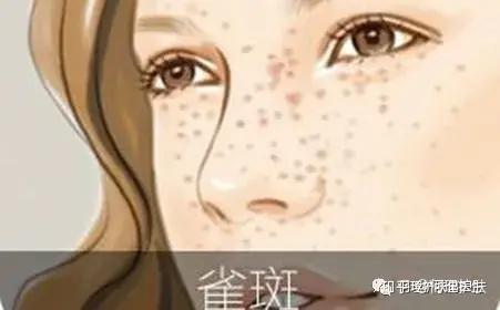 可见一“斑”,色斑及色沉的预防及治疗!-可见一斑为什么是斑点的斑?