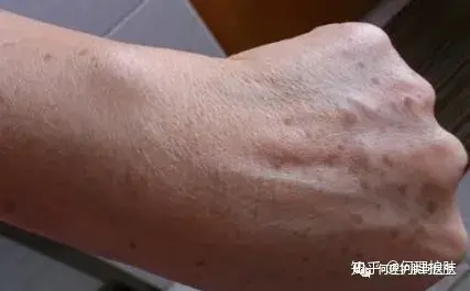 可见一“斑”,色斑及色沉的预防及治疗!-可见一斑为什么是斑点的斑?