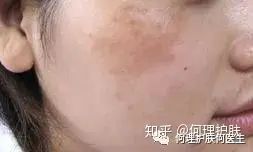 可见一“斑”,色斑及色沉的预防及治疗!-可见一斑为什么是斑点的斑?