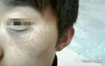 可见一“斑”,色斑及色沉的预防及治疗!-可见一斑为什么是斑点的斑?