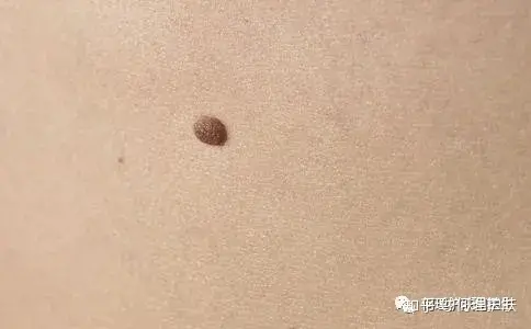 可见一“斑”,色斑及色沉的预防及治疗!-可见一斑为什么是斑点的斑?