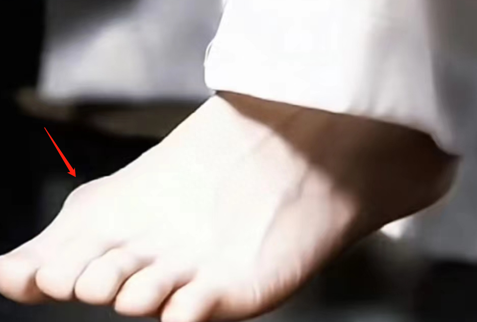 成毅缺陷曝光,拇指外翻遗传,团队撇清关系,网友建议就医治疗-成毅脸歪