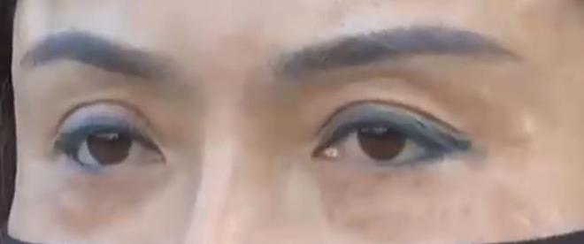 花15500做面部提拉,女子术后只能戴口罩示人,医师回应令人愤恨-面部提升带