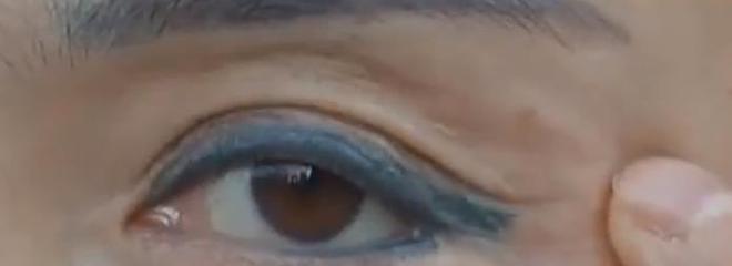 花15500做面部提拉,女子术后只能戴口罩示人,医师回应令人愤恨-面部提升带