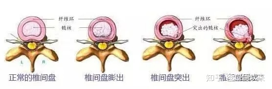 腰椎间盘突出症的治疗方法(完整版)-腰椎间盘突出症的治疗方式
