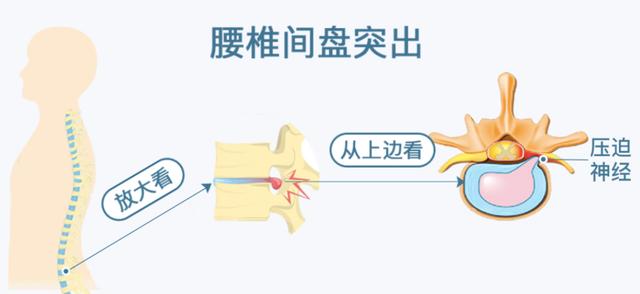 体医科普|腰椎间盘比业绩更突出?五种锻炼方法有助缓解-腰椎间盘突出该怎么锻炼效果较佳