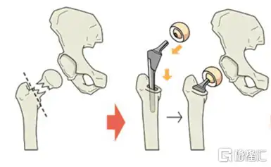 医疗器械集采靴子落地:春立医疗涨到停牌!