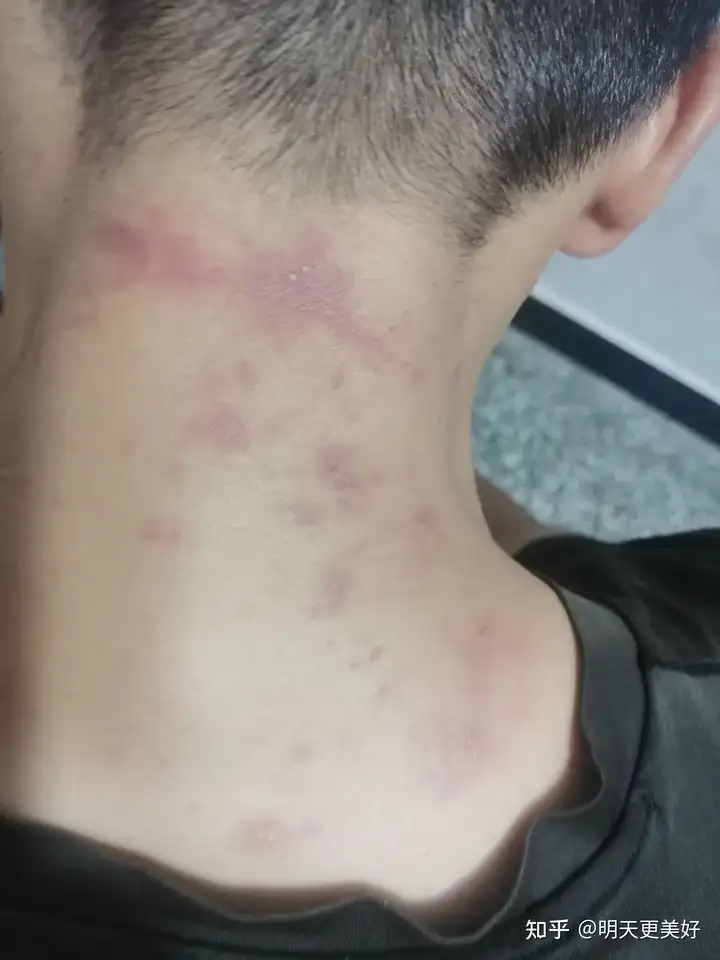 脖子上拍了个隐翅虫会有怎样的下场?