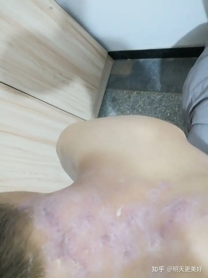 脖子上拍了个隐翅虫会有怎样的下场?