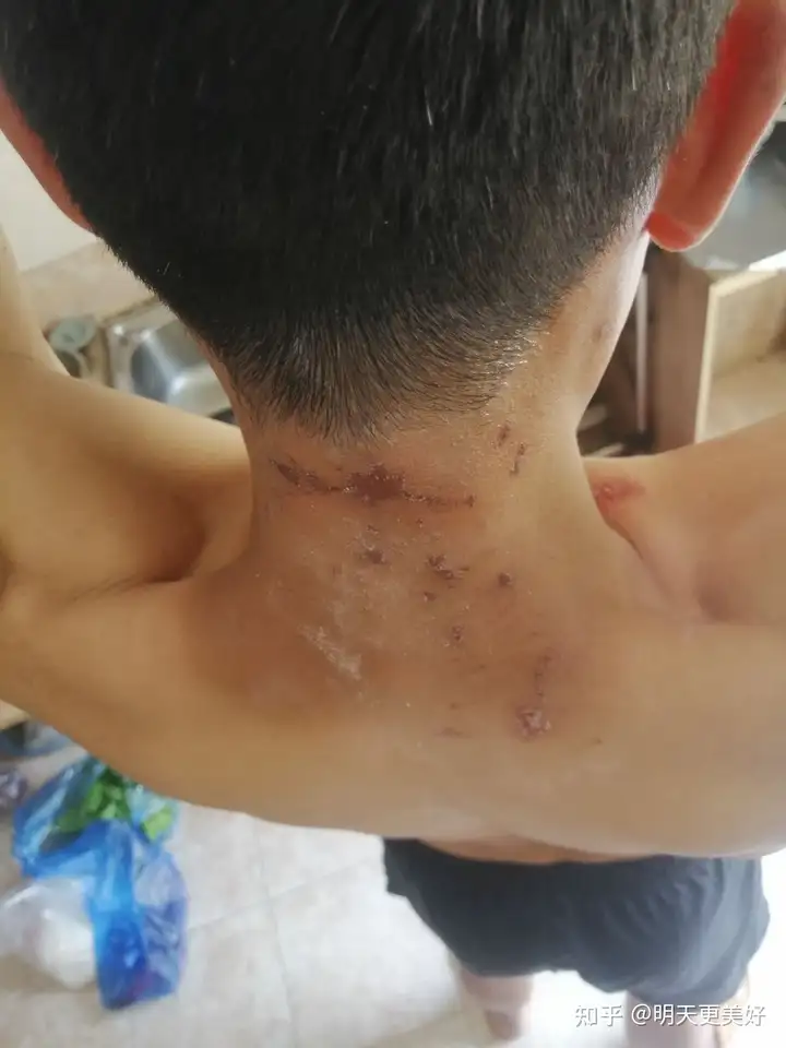 脖子上拍了个隐翅虫会有怎样的下场?