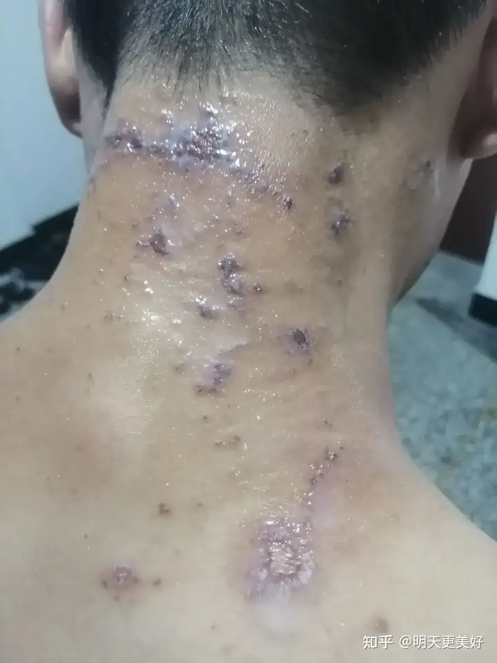 脖子上拍了个隐翅虫会有怎样的下场?