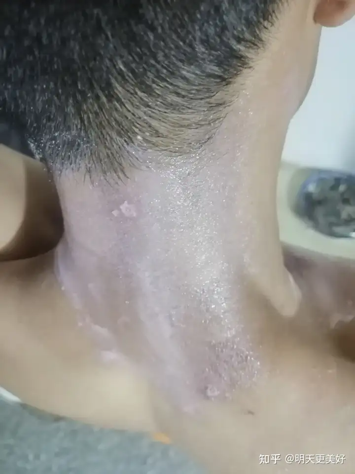 脖子上拍了个隐翅虫会有怎样的下场?