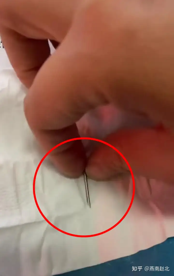 保定一男子猪肉中吃出3厘米长针头,嘴被扎伤连夜就医,该咋赔?