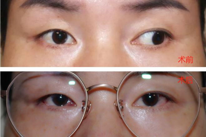 无法“正眼”看人,宁德女子忍了30多年……最终在这家医院解开心结