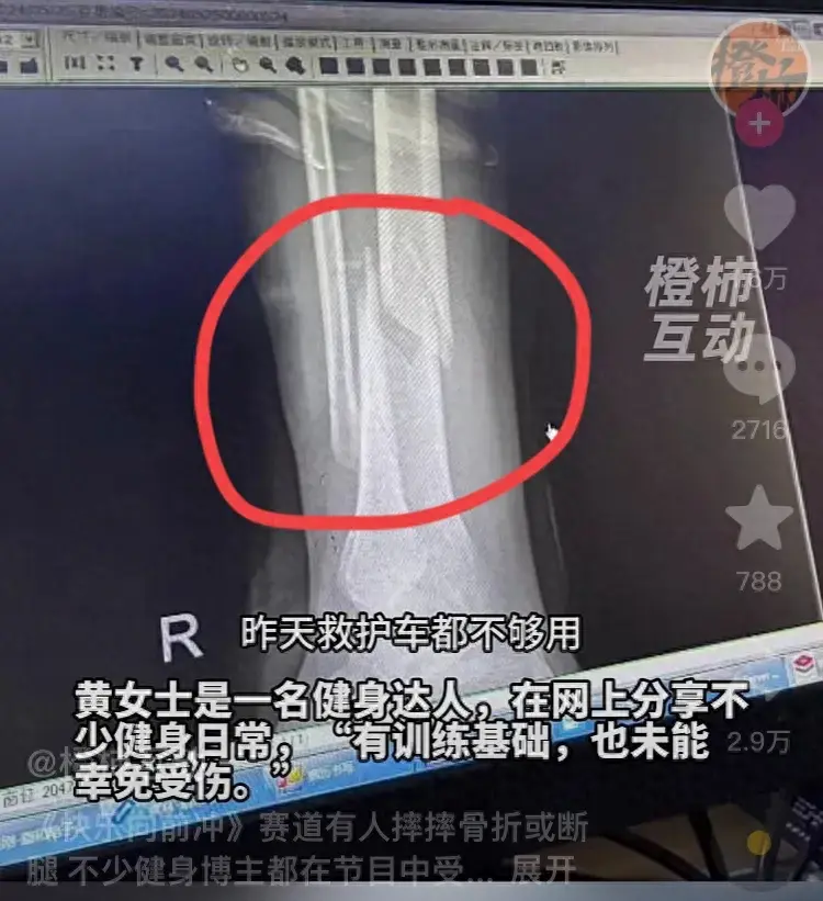 闹大了,女子参加《快乐向前冲》摔断腿冲上热搜,评论区炸锅