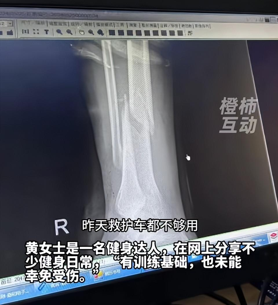 女子参加《快乐向前冲》摔断腿,参赛人员爆出90%的人都有受伤