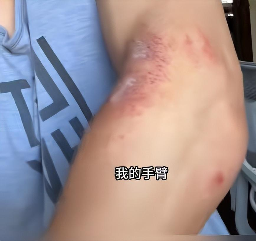 女子参加《快乐向前冲》摔断腿,参赛人员爆出90%的人都有受伤