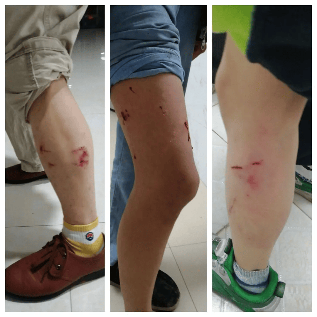 3条狗咬伤16人,一名儿童面部被咬伤!最新情况→-三只狗咬孩子