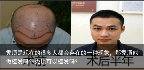 秃顶是现在的很多人都会存在的一种现象，那秃顶能做植发吗?-秃顶可以植发吗?