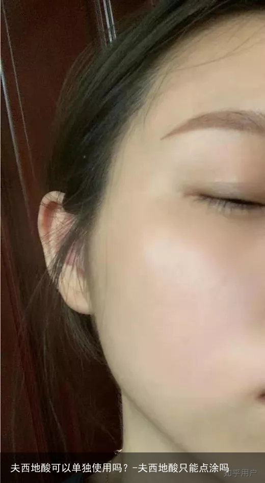 夫西地酸可以单独使用吗？-夫西地酸只能点涂吗