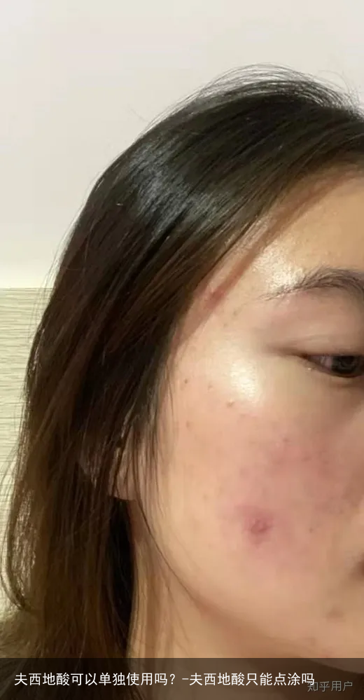 夫西地酸可以单独使用吗？-夫西地酸只能点涂吗