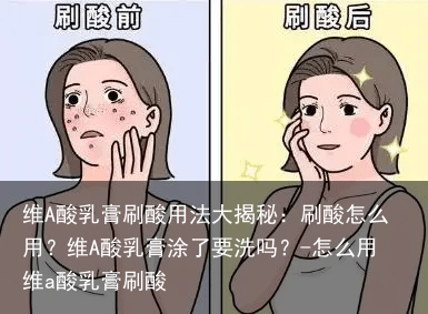 维A酸乳膏刷酸用法大揭秘：刷酸怎么用？维A酸乳膏涂了要洗吗？-怎么用维a酸乳膏刷酸