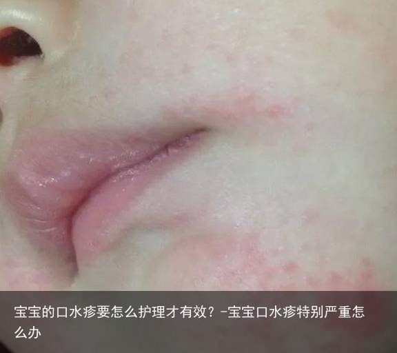 宝宝的口水疹要怎么护理才有效？-宝宝口水疹特别严重怎么办