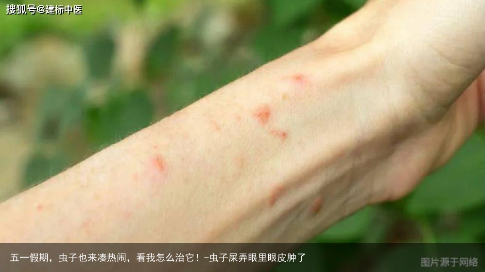 五一假期，虫子也来凑热闹，看我怎么治它！-虫子屎弄眼里眼皮肿了