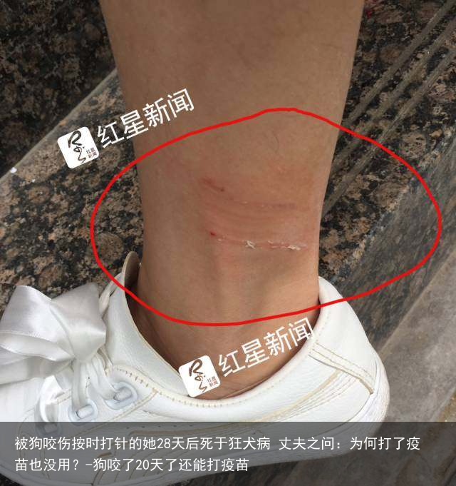 被狗咬伤按时打针的她28天后死于狂犬病 丈夫之问：为何打了疫苗也没用？-狗咬了20天了还能打疫苗