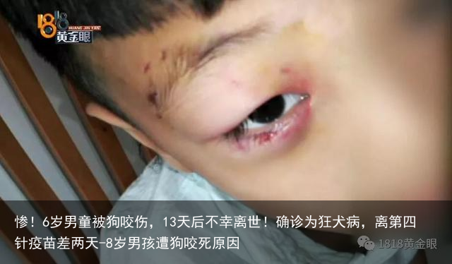 惨！6岁男童被狗咬伤，13天后不幸离世！确诊为狂犬病，离第四针疫苗差两天-8岁男孩遭狗咬死原因