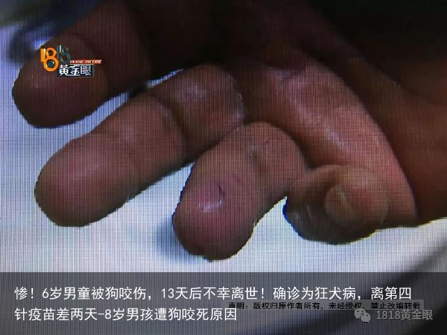惨！6岁男童被狗咬伤，13天后不幸离世！确诊为狂犬病，离第四针疫苗差两天-8岁男孩遭狗咬死原因