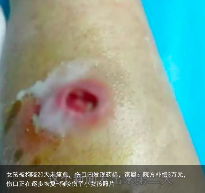 女孩被狗咬20天未痊愈，伤口内发现药棉，家属：院方补偿3万元，伤口正在逐步恢复-狗咬伤了小女孩照片