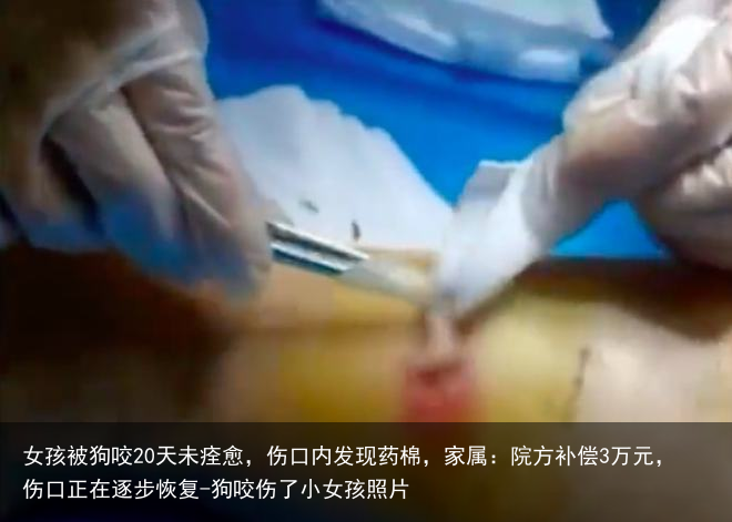 女孩被狗咬20天未痊愈，伤口内发现药棉，家属：院方补偿3万元，伤口正在逐步恢复-狗咬伤了小女孩照片