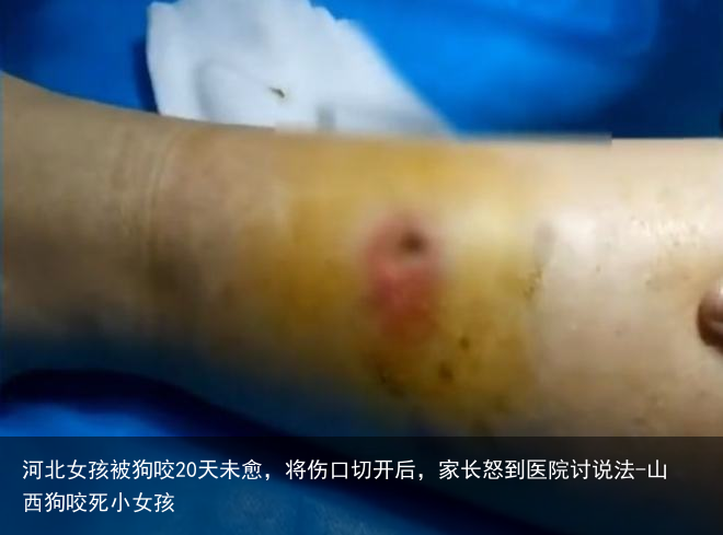 河北女孩被狗咬20天未愈，将伤口切开后，家长怒到医院讨说法-山西狗咬死小女孩
