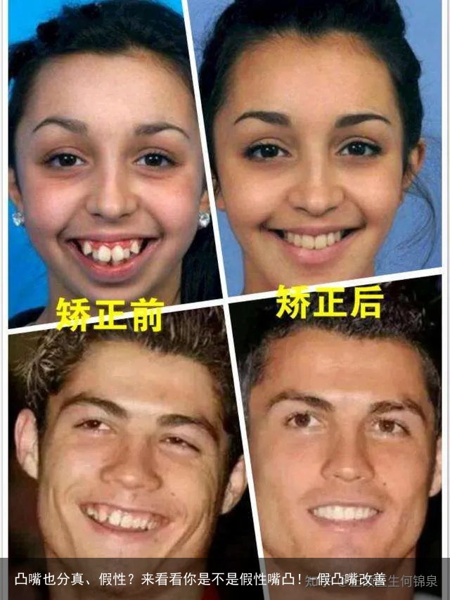 凸嘴也分真、假性？来看看你是不是假性嘴凸！-假凸嘴改善