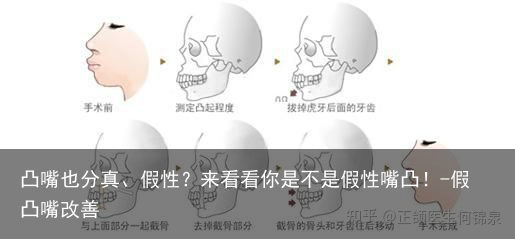 凸嘴也分真、假性？来看看你是不是假性嘴凸！-假凸嘴改善