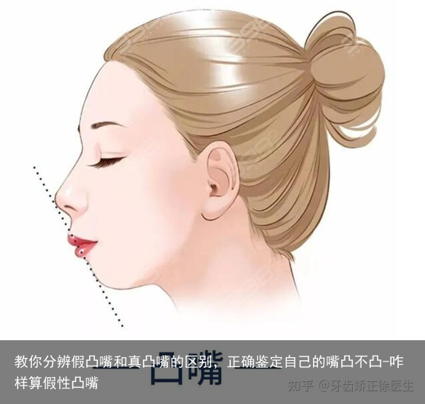 教你分辨假凸嘴和真凸嘴的区别，正确鉴定自己的嘴凸不凸-咋样算假性凸嘴
